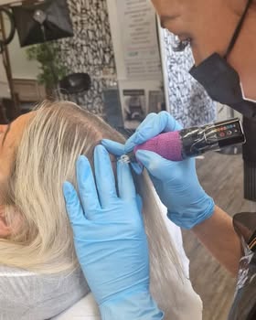 How Scalp Micropigmentation helped restore confidence after hair loss