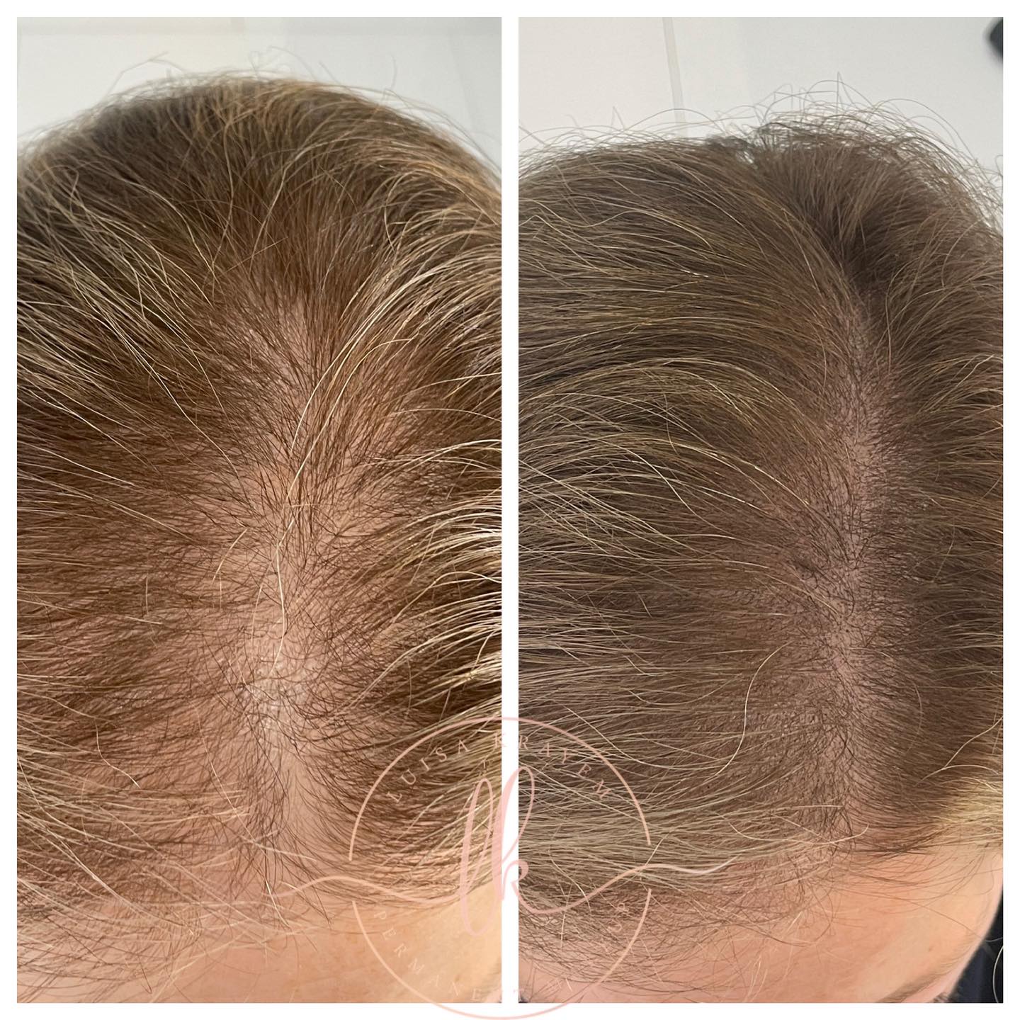 Female Scalp Densificaton