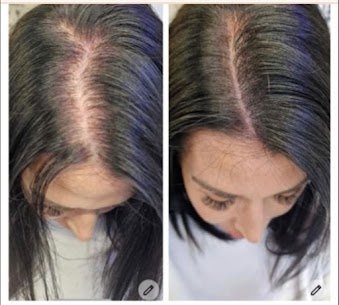 Is thinning hair getting you down?