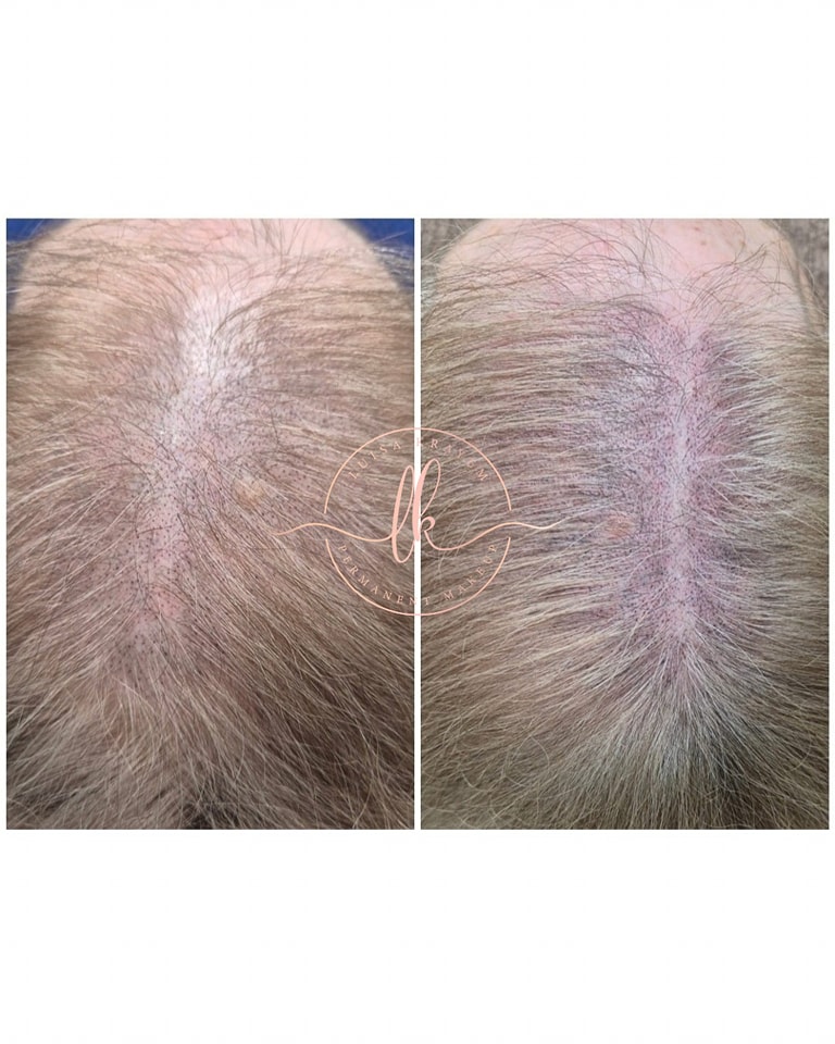 Let’s talk about hair loss