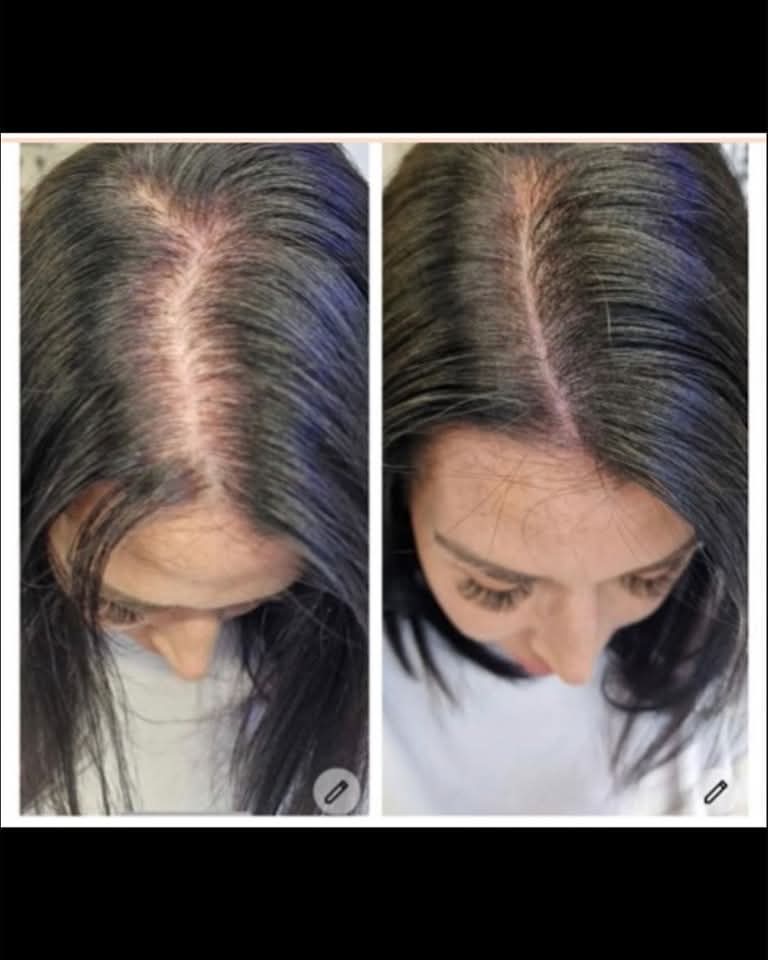 Thinning Hair? Scalp Micropigmentation Could Be the Secret You’ve Been Looking For