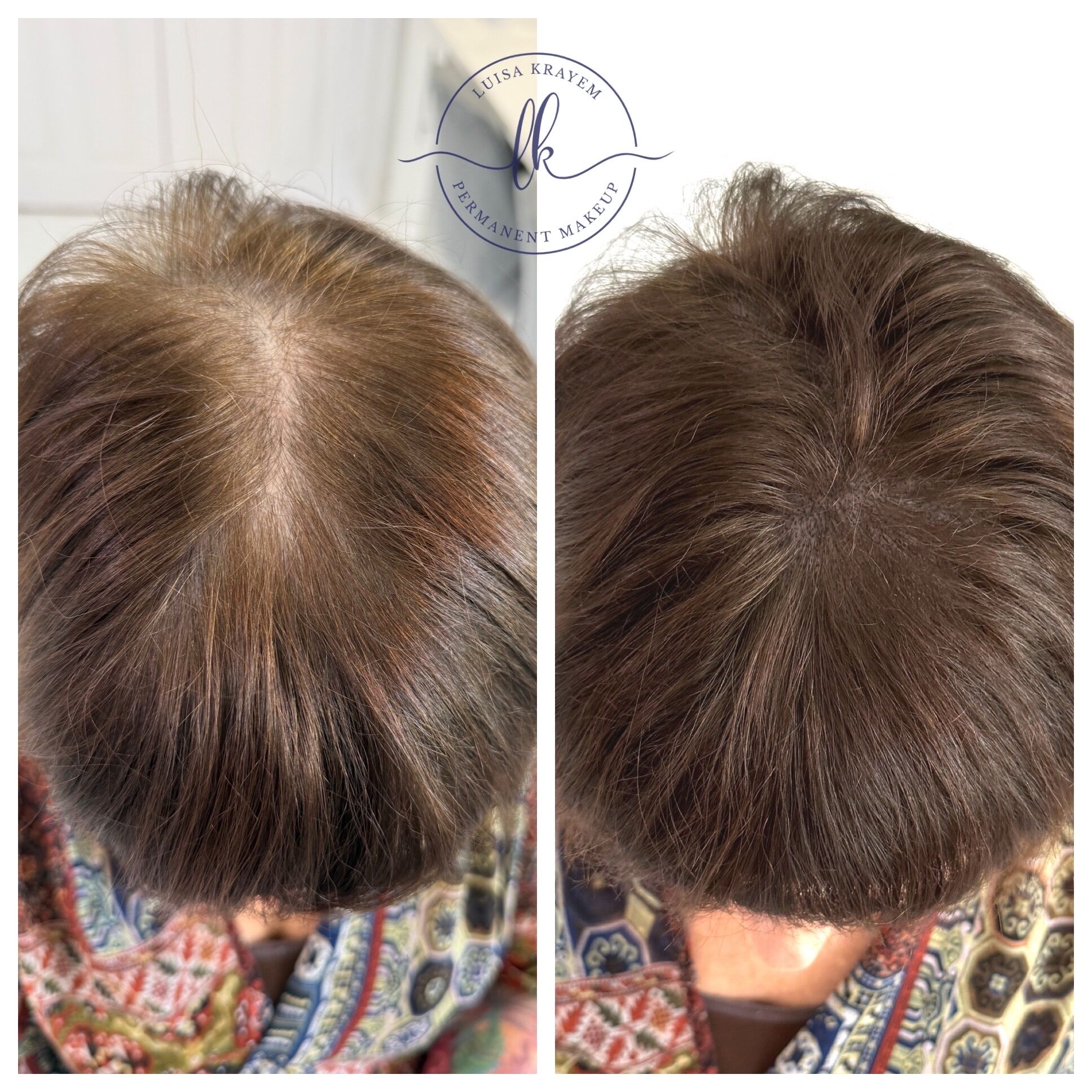 Restoring Confidence with Scalp Micropigmentation in Tetbury