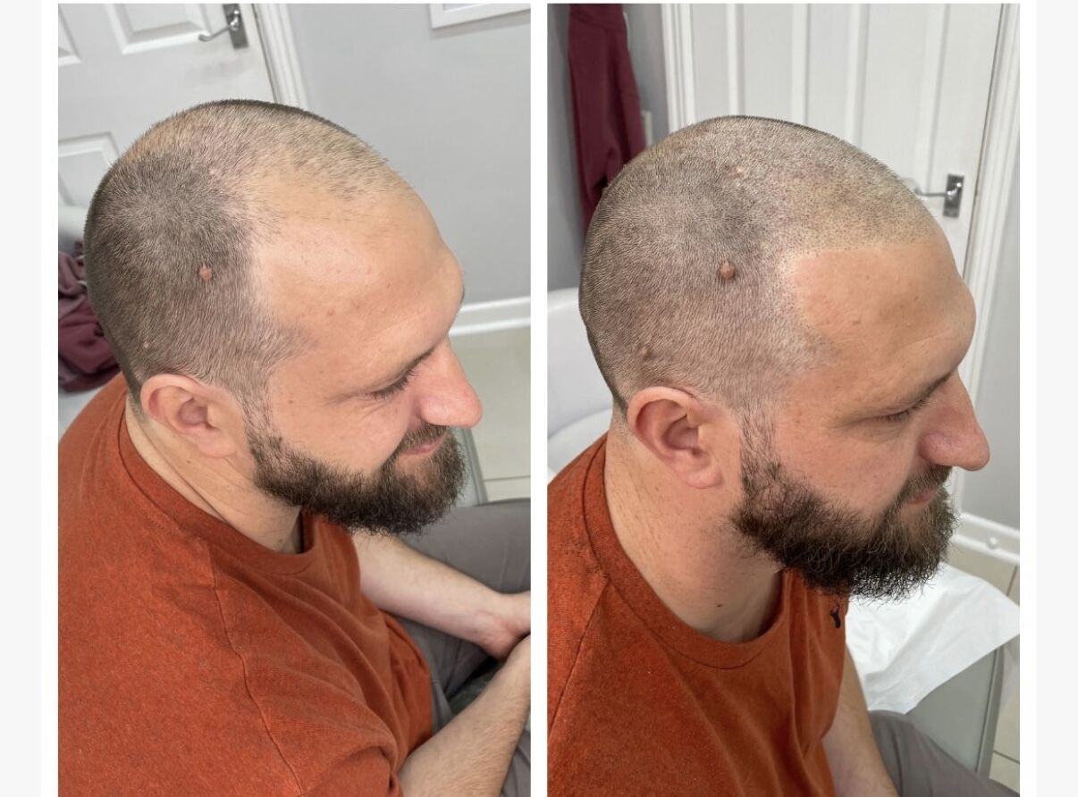 Getting His Confidence Back: Luke’s Scalp Micropigmentation Story